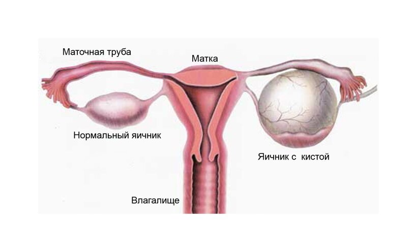 Киста яичников: виды, диагностика, лечение